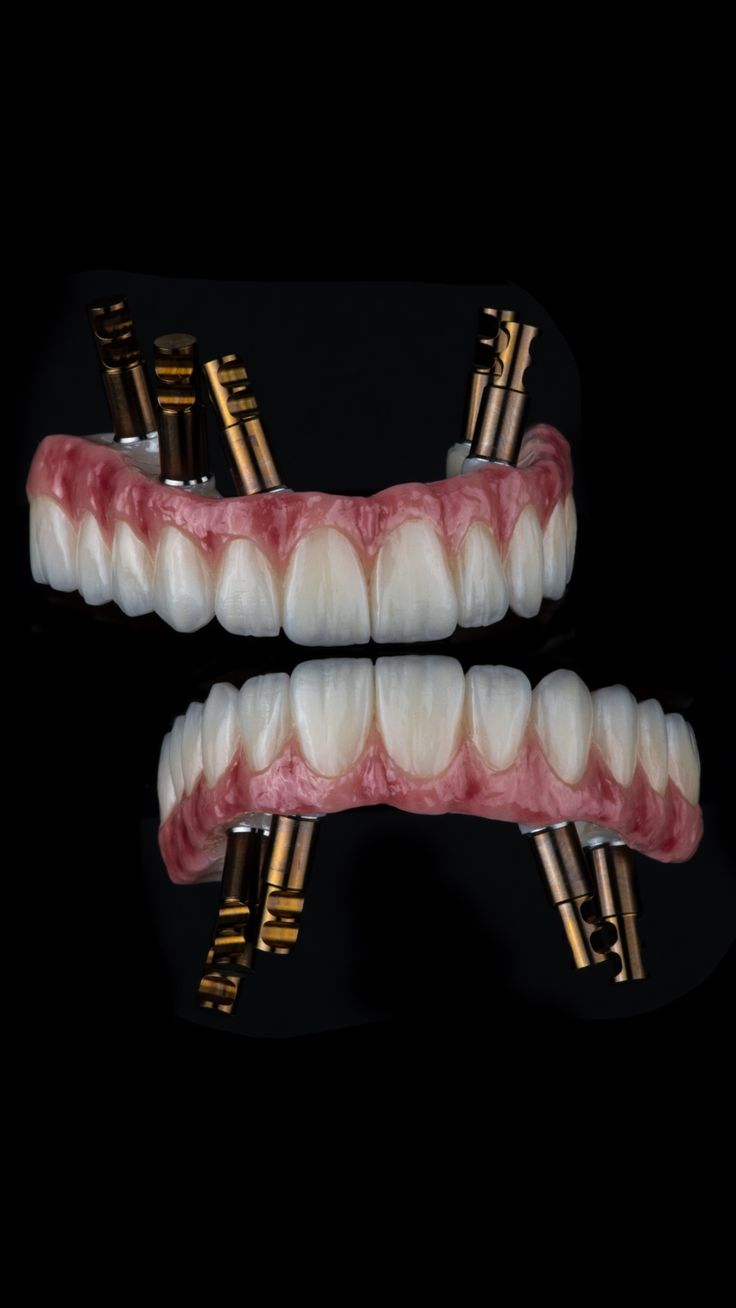 Full arch zirconia restoration produced by Praxis Millworks